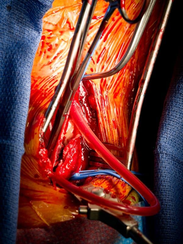 Arm vascular surgery